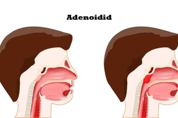 Proven Ways to Treat Adenoidid: Full Guide & Symptoms Adenoiditis ventsmagazines.co.uk