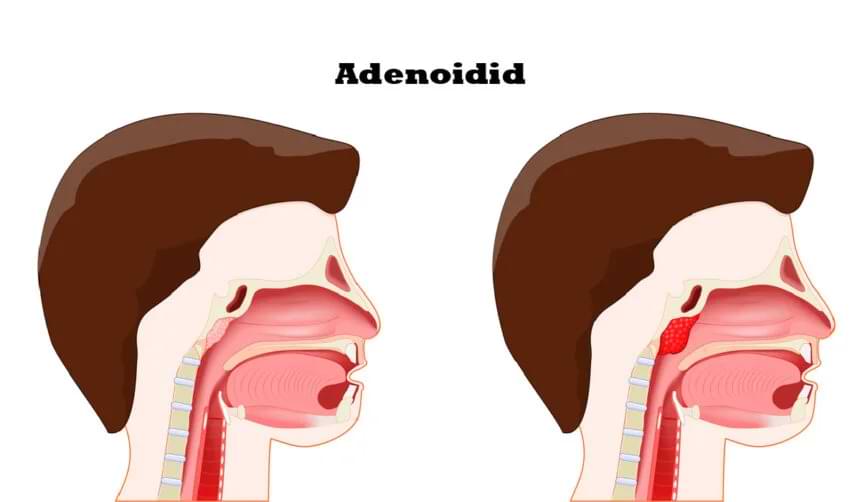 Adenoiditis ventsmagazines.co.uk
