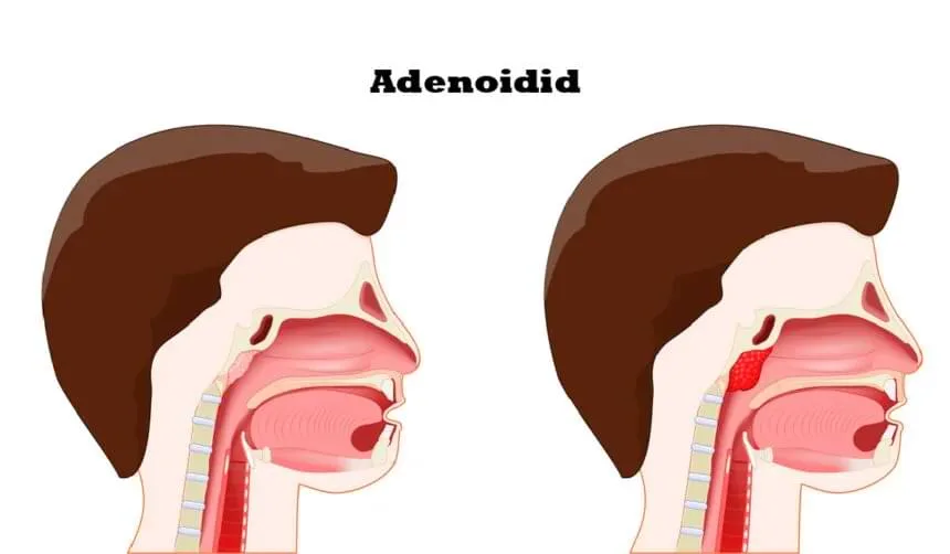 Adenoiditis ventsmagazines.co.uk