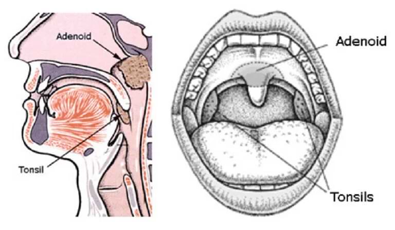 How Do Doctors Diagnose Adenoidid?ventsmagazines.co.uk
