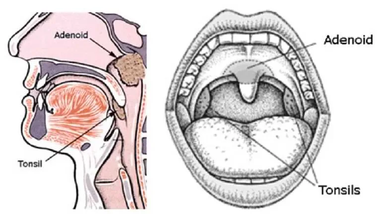 How Do Doctors Diagnose Adenoidid?ventsmagazines.co.uk
